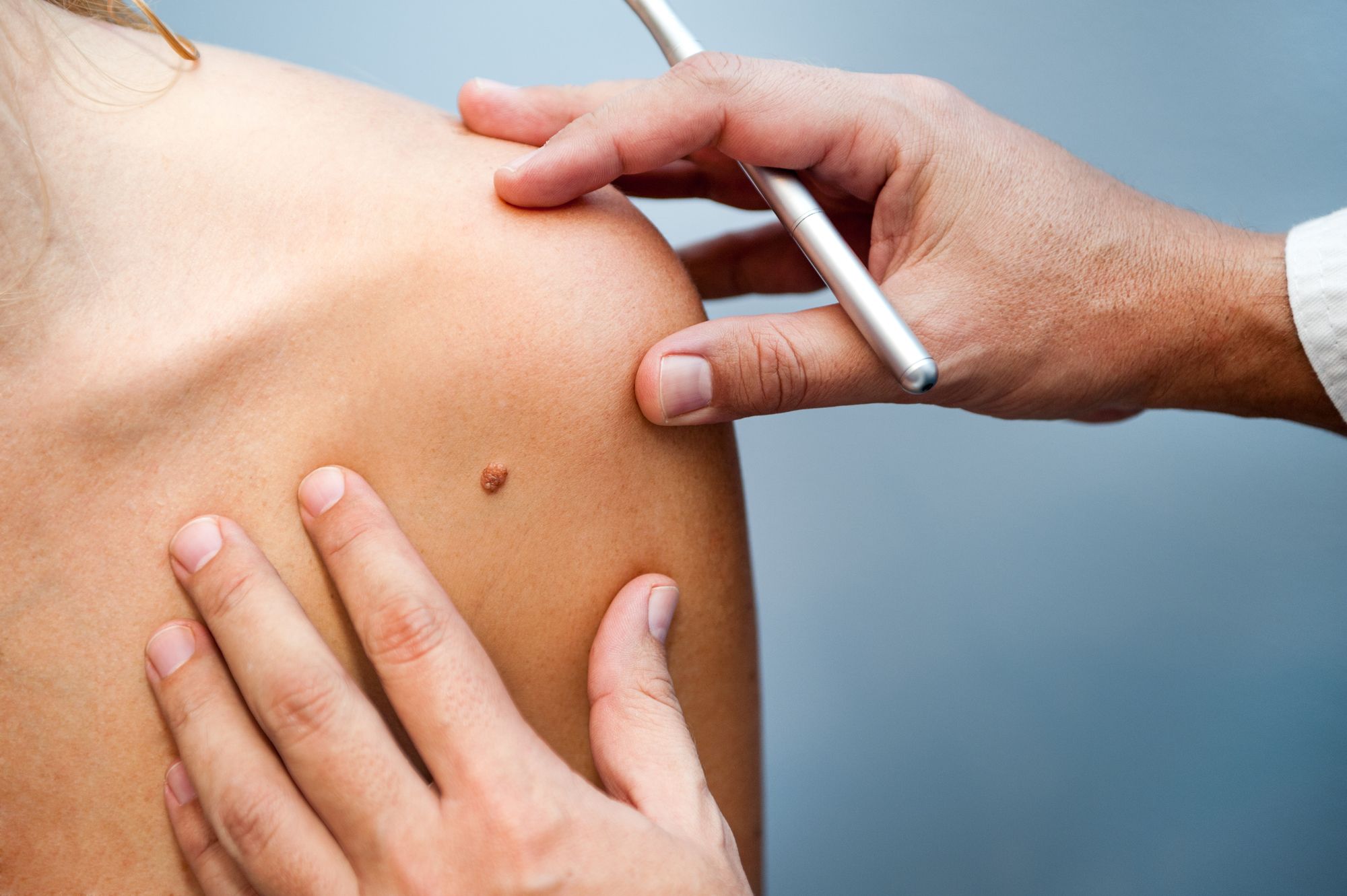 Skin Cancer Surgery